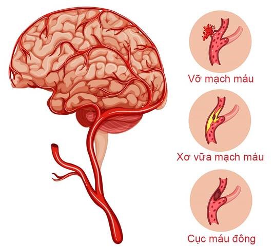 thực phẩm phòng ngừa đột quy