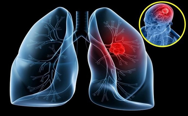 Bệnh ung thư phổi: nguyên nhân, biểu hiện và cách điều trị