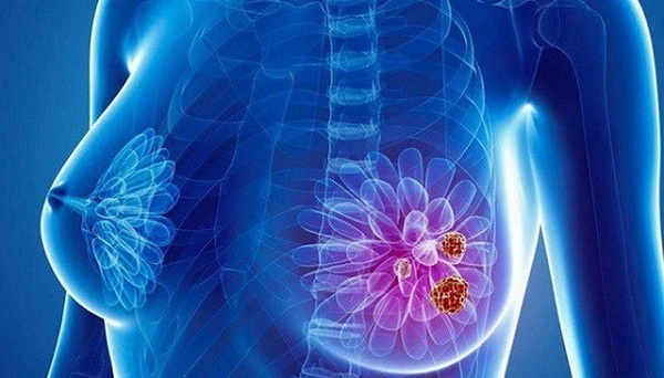 Bệnh ung thư vú: nguyên nhân, biểu hiện và cách điều trị